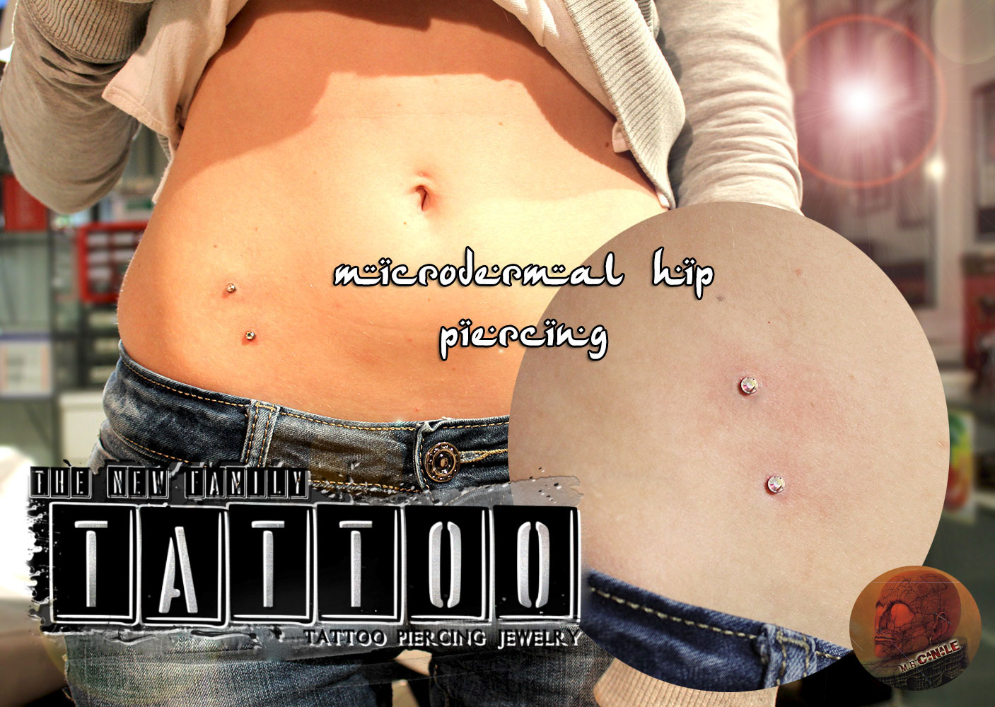 hipmicrodermal